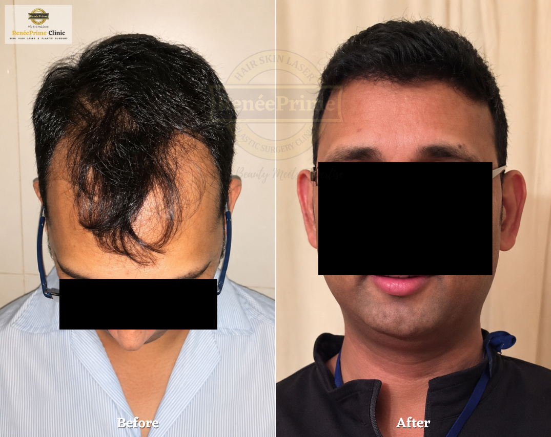 FUE Hair transplant in Mumbai before and after