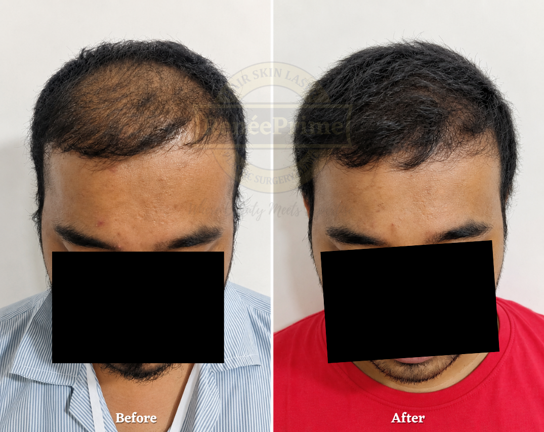 PRP Hair treatment in Mumbai before and after