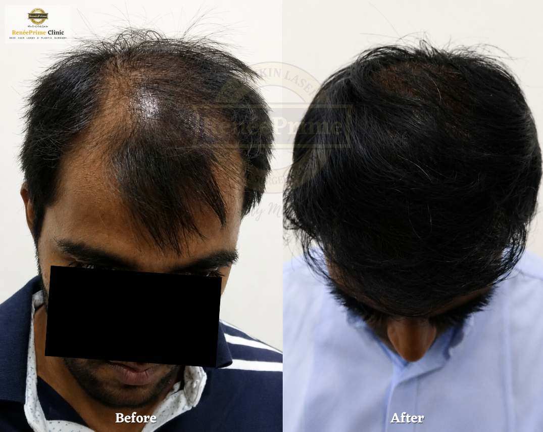 Hair treatment in Mumbai before and after