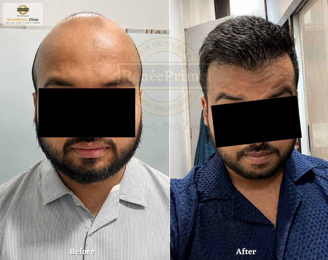body to scalp Hair transplant in Mumbai before and after