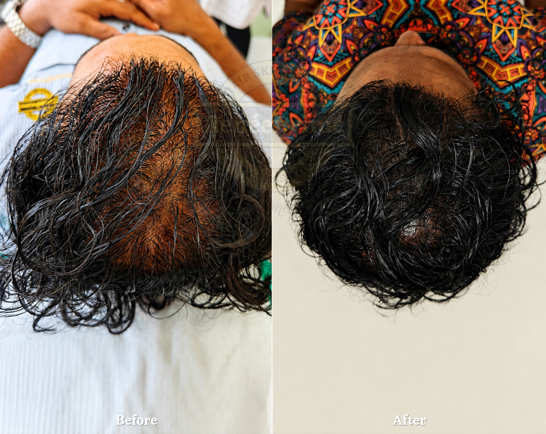 scalp mircopigmentation SMP results before and after